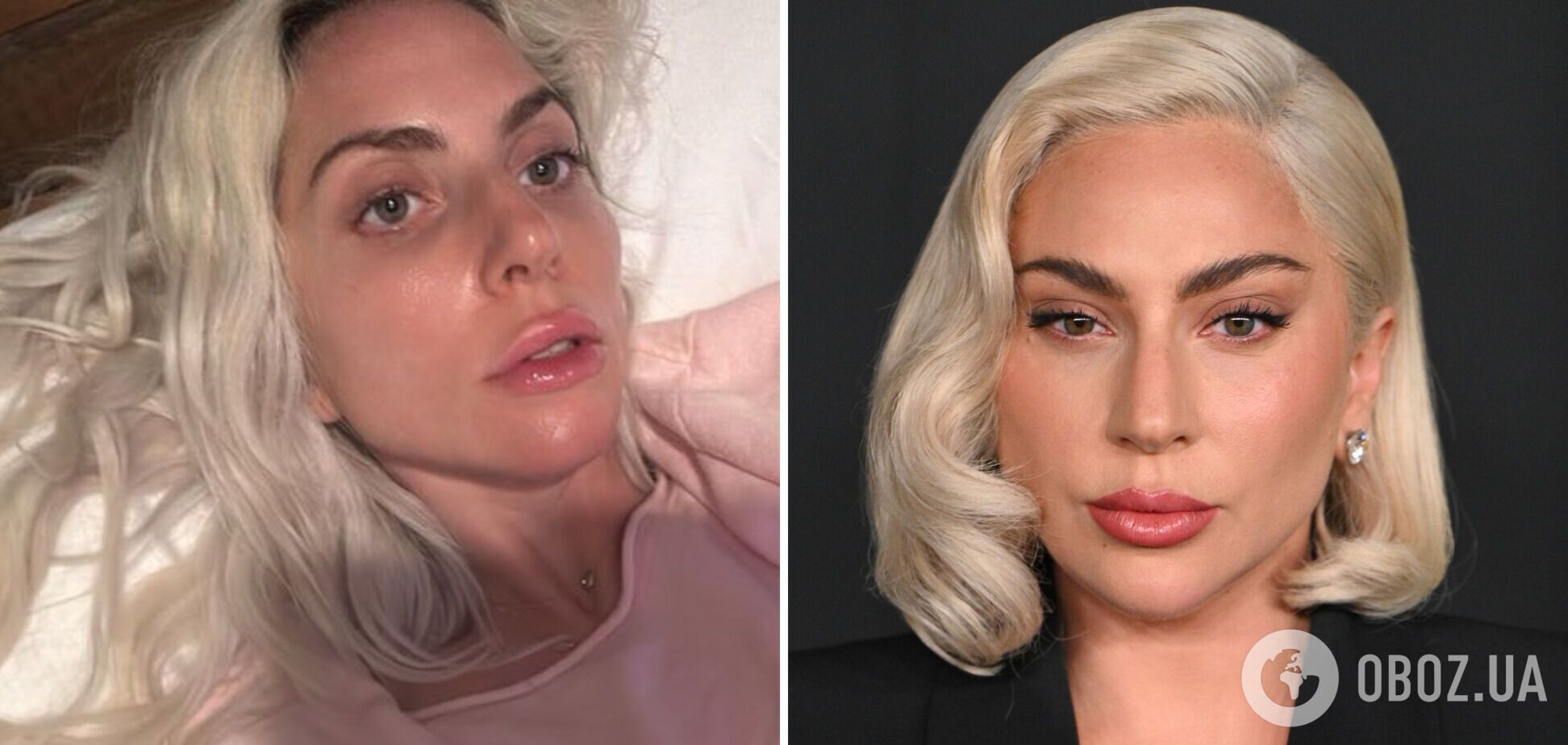 37-річна Леді Гага розчарувала шанувальників через 'ботокс і філери' в обличчі. Фото до і після