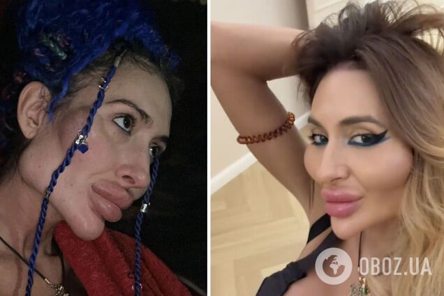 Украинка с крупнейшими скулами в мире набросилась на звезд, которые публично рассказывают о своей благотворительности