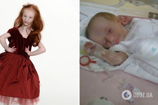 Найменша дівчинка в світі, яка вижила всупереч прогнозам лікарів, відсвяткувала 16 років. Фото Дюймовочки