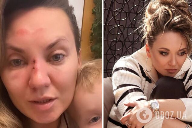'Поскользнулась и перелом': Саливанчук заставила фанов понервничать, показав изуродованное лицо