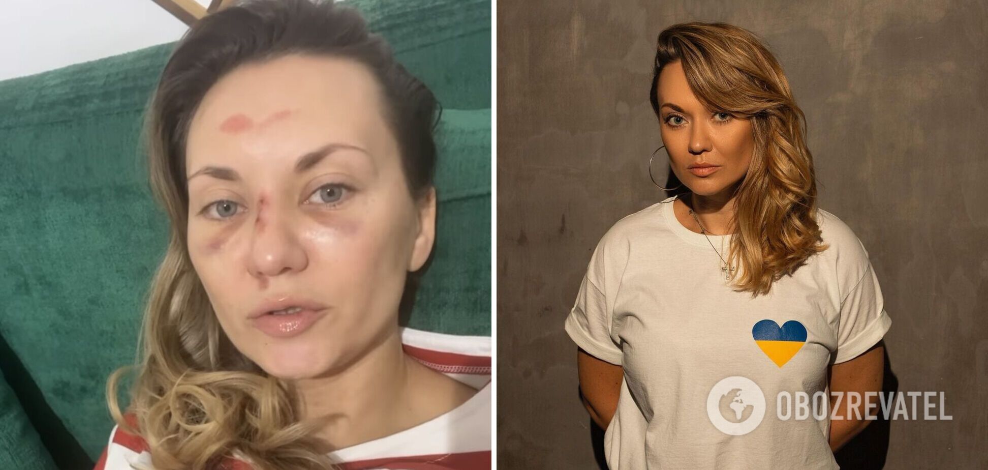 Саліванчук після травми обличчя з'явилася на ТБ та поділилися подробицями свого падіння: у мене струс мозку і зміщення