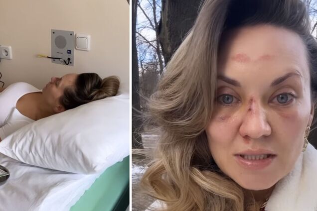 Саліванчук, яка серйозно травмувала обличчя та голову, готується до операції: буду плакати, якщо говоритиму про це