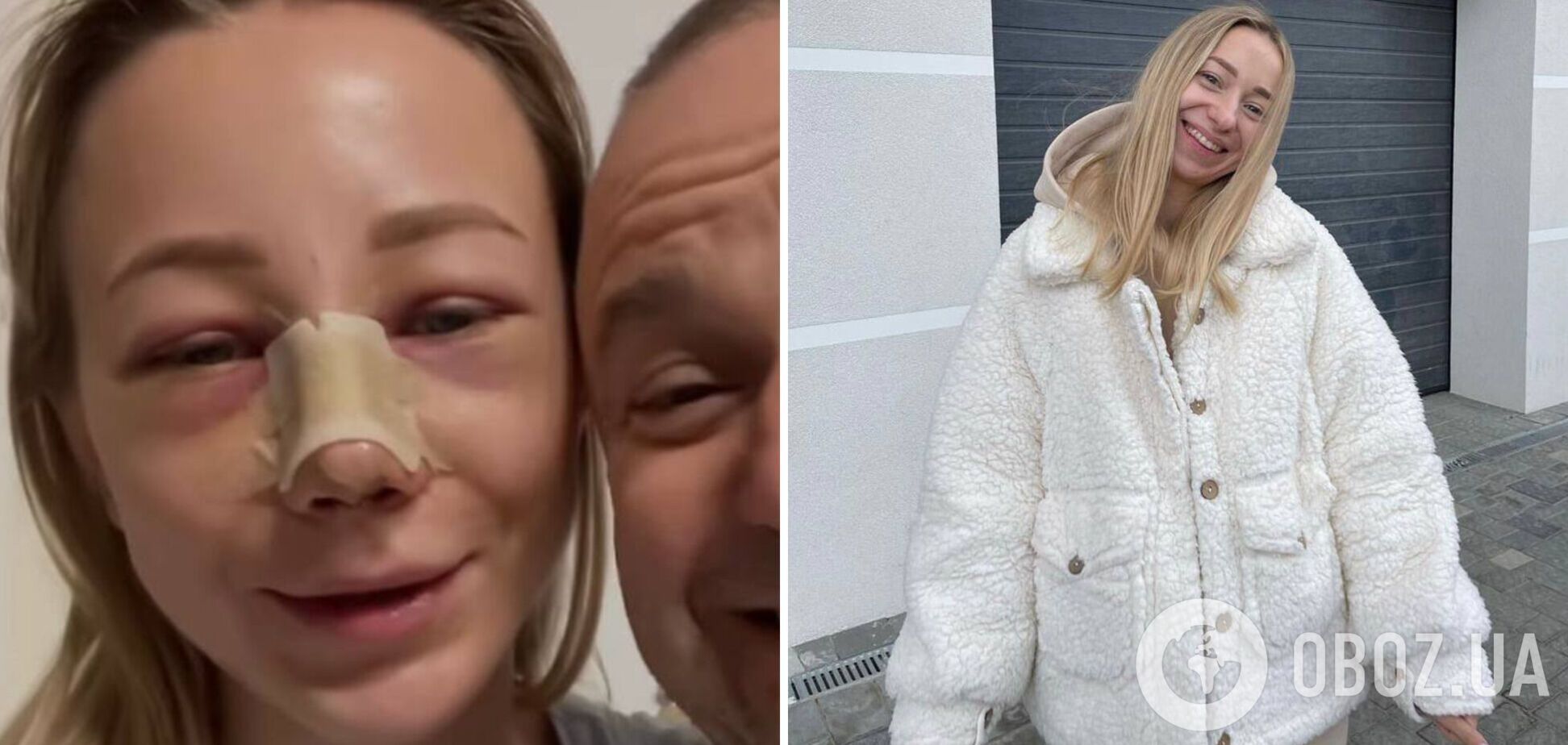 'Резко стало плохо': Репяхова показала, как выглядит после пластики, и рассекретила стоимость операции. Фото