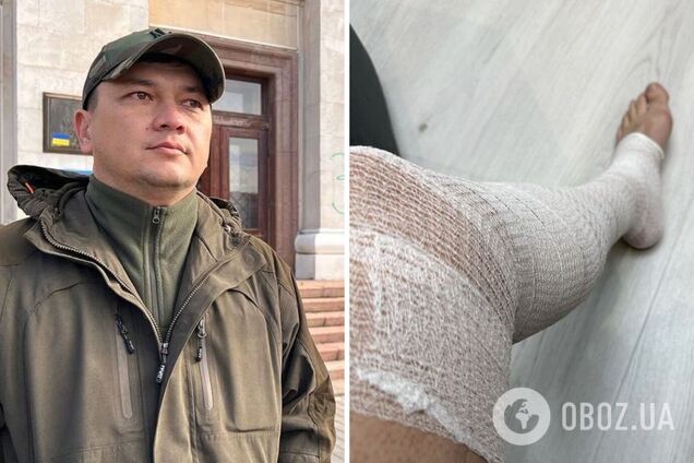 Виталий Ким серьезно травмировался во время занятий спортом и показал фото: ходить запрещают