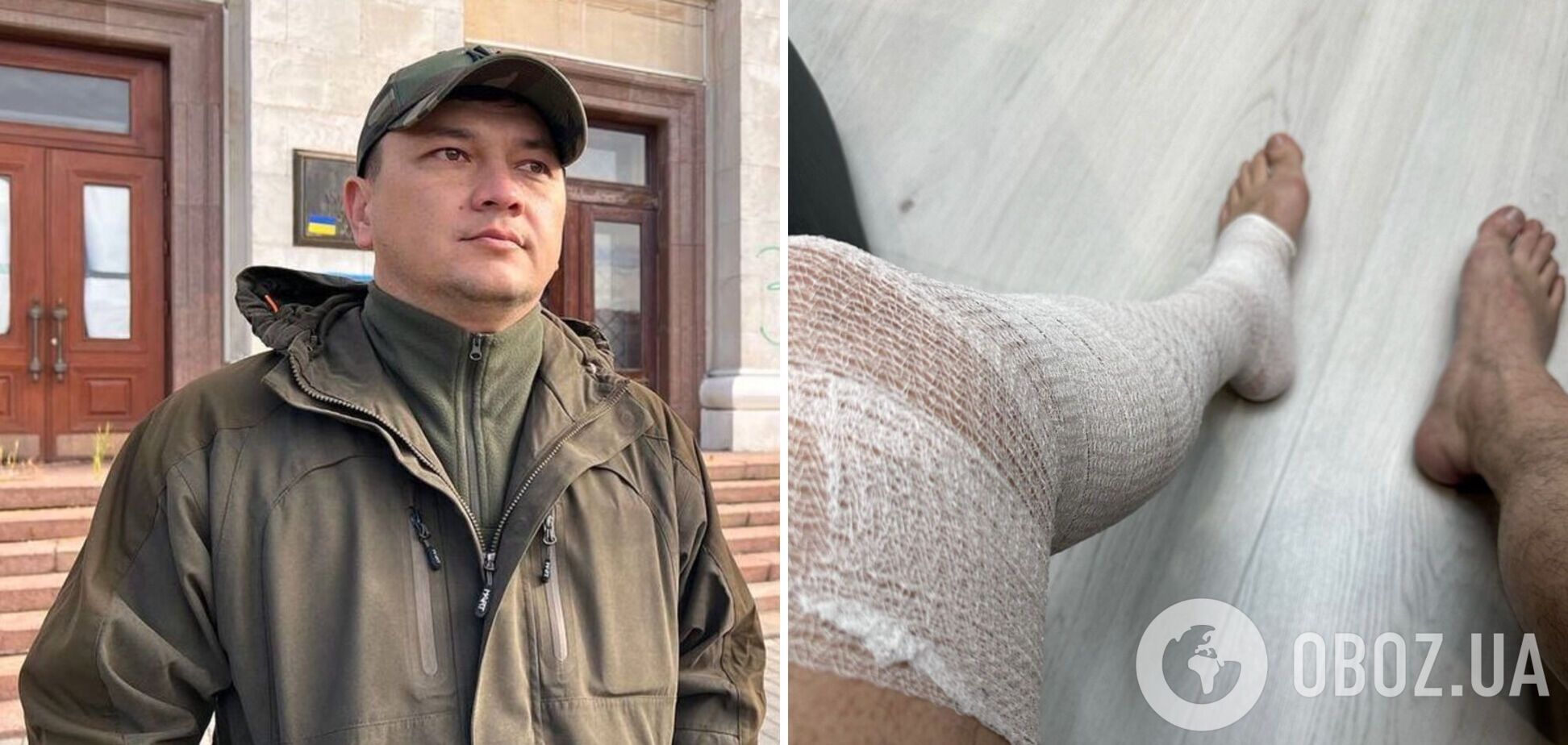 Віталій Кім серйозно травмувався під час занять спортом і показав фото: ходити забороняють