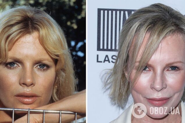 Бывшая жена Алека Болдуина удивила поклонников 'неузнаваемым' лицом после неудачной пластики. Фото