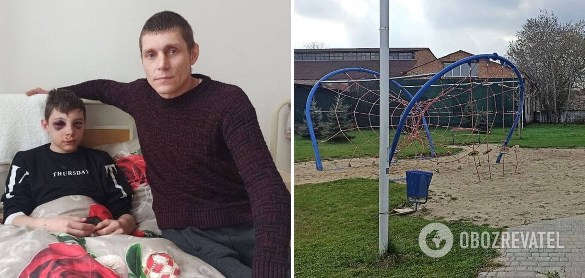 Получил переломы костей черепа: на Кировоградщине на 14-летнего школьника упали качели, ребенок попал в больницу. Фото