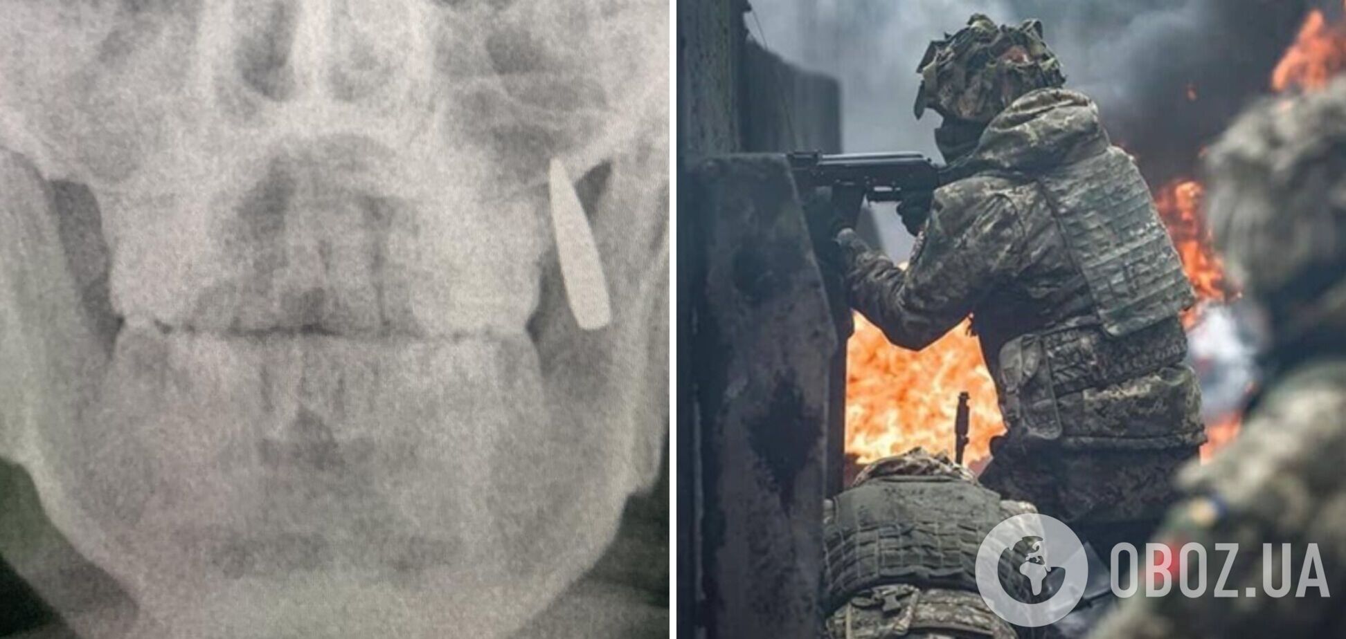 У воина ВСУ в челюсти застряла пуля: он узнал об этом только после рентгена