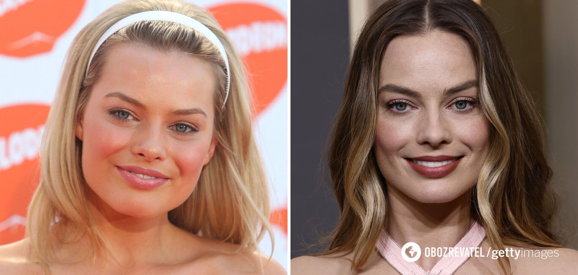 Позбулися пухких щік: 5 знаменитостей, які видалили грудки Біша. Фото до і після