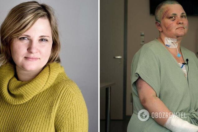 Жестоко избили и побрили налысо: появились фото журналистки, на которую напали в Чечне