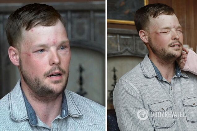 Врачи в США сделали пересадку лица