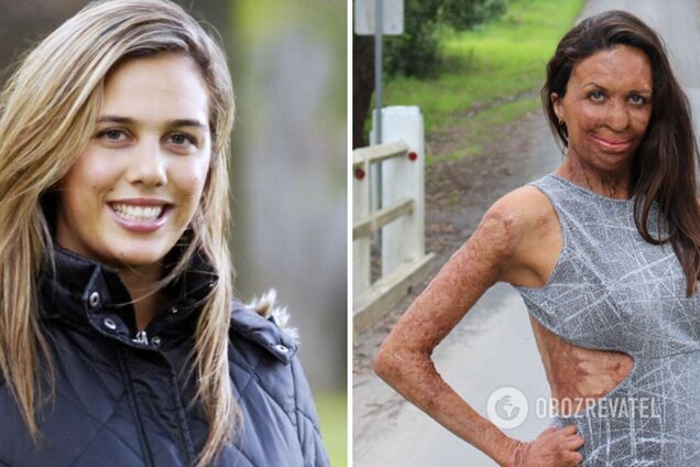 Прошли через боль, но не сломались: как сложилась судьба знаменитых красавиц, которых облили кислотой. Фото