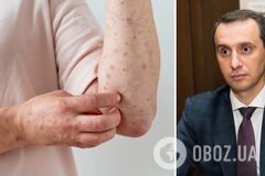 Украине грозит вспышка кори: в Минздраве рассказали подробности