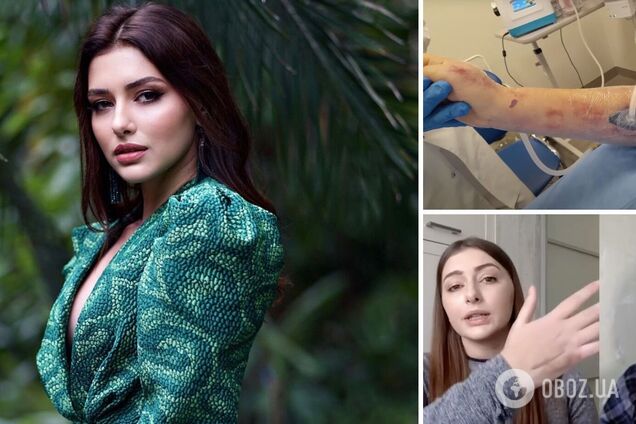 Екатерина Тышкевич впервые показала руку, которую заразили в психбольнице стафилококком, и объяснила, почему не будет подавать в суд