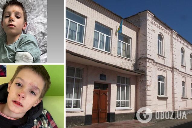 У гімназії Василькова під Києвом хлопчик зіштовхнув однокласника з висоти: дитина отримала травму голови та перелом руки
