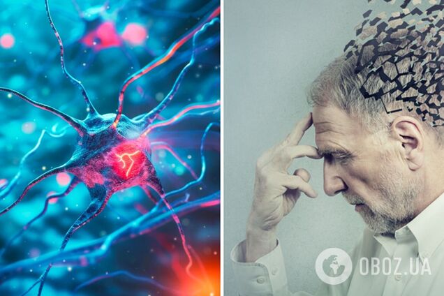 Хвороба Альцгеймера може передаватися від людини до людини, але в рідкісних випадках: вчені пояснили, про що йде мова