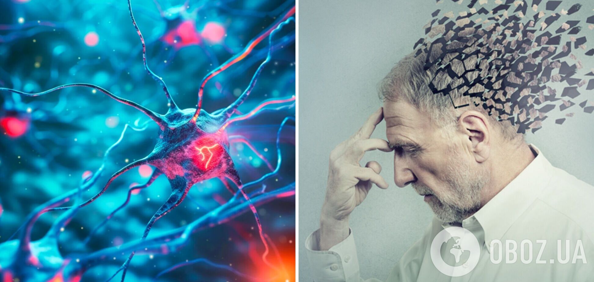 Болезнь Альцгеймера может передаваться от человека к человеку, но в редких случаях: ученые объяснили, о чем идет речь