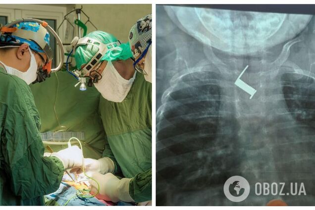 Два тижні лікували від 'бронхіту': в Одесі врятували немовля, яке проковтнуло пружину. Фото