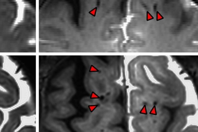 Вчені вперше склали карту 'каналізаційної системи' людського мозку
