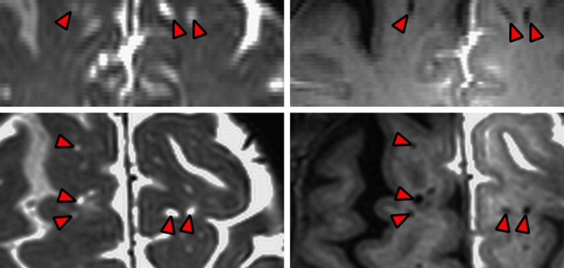 Вчені вперше склали карту 'каналізаційної системи' людського мозку