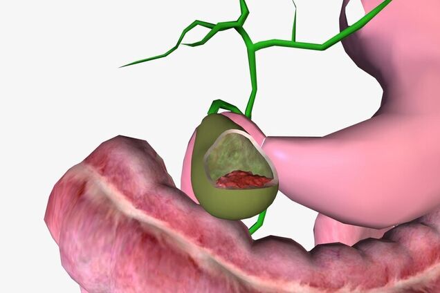 Как распознать рак желчного пузыря: основные симптомы заболевания