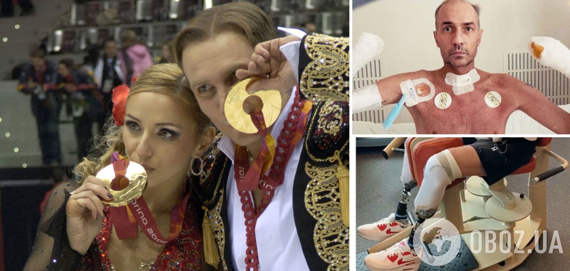 Чемпіону ОІ з Росії ампутували руки та ноги впродовж кількох місяців