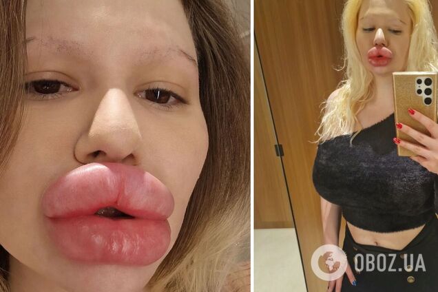 Жінка з найбільшими губами в світі зробила 6 'уколів краси' за один день, хоча лікарі попереджували, що її тіло почне гнити. Фото