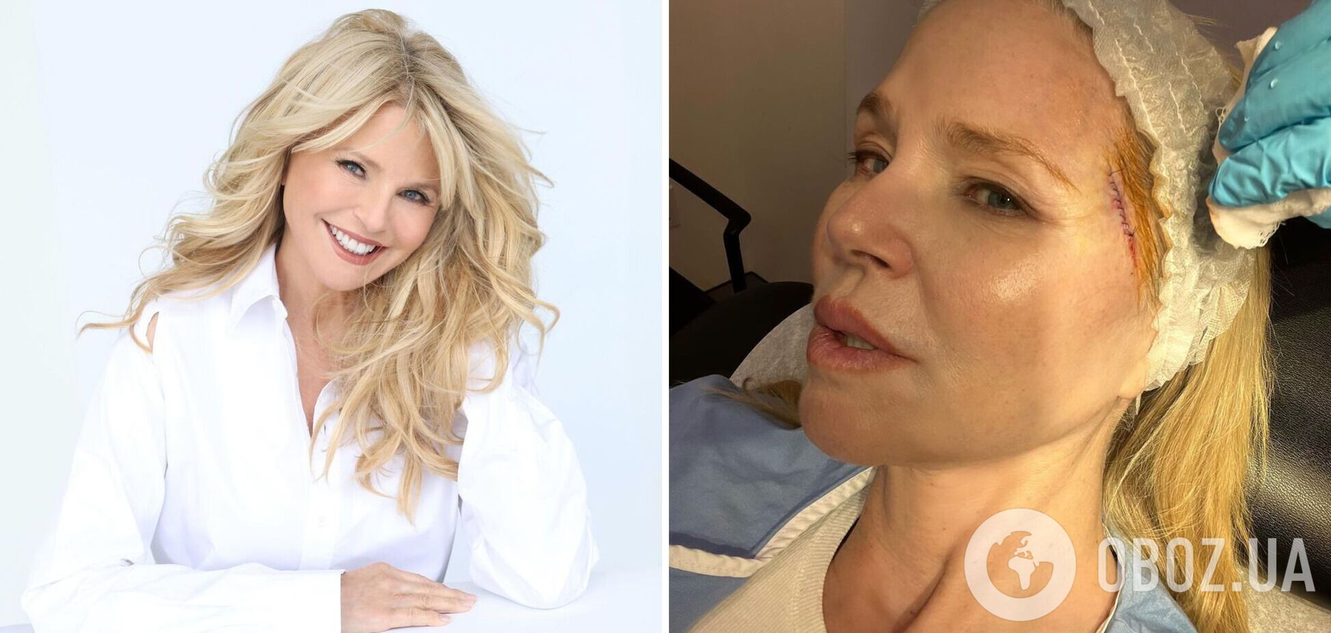 У Кристи Бринкли обнаружили рак кожи: 70-летняя супермодель показала первые фото после операции