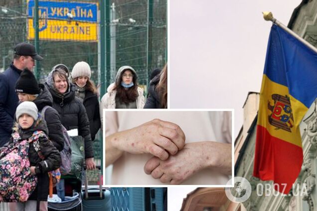  У кишинівському центрі для біженців з України зафіксували спалах кору: що відбувається