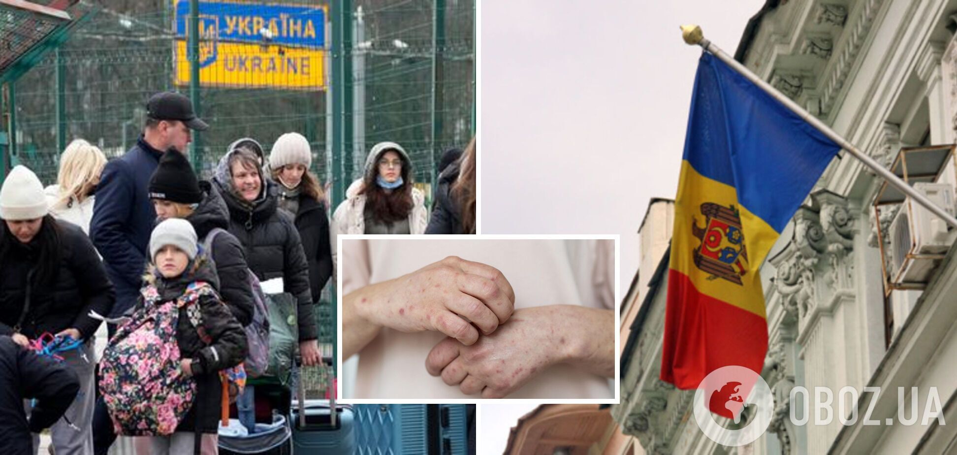 В кишиневском центре для беженцев из Украины зафиксировали вспышку кори: что происходит