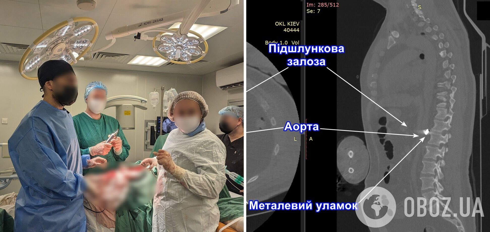 Українські лікарі провели надскладну операцію, врятувавши воїнові життя: уламок був на стінці аорти