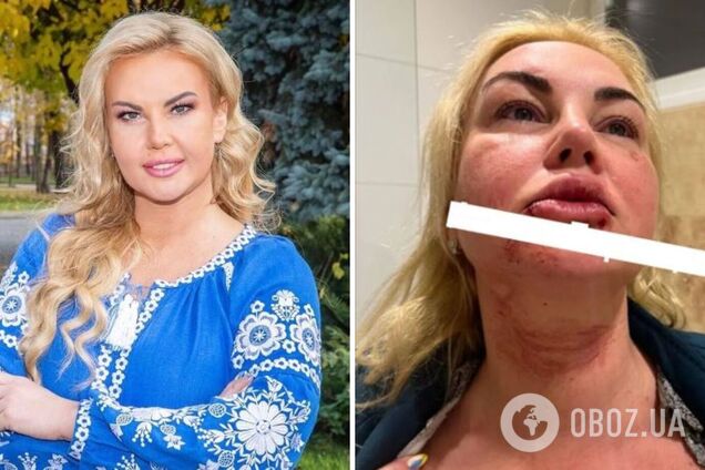 'Почали зливати ці фото'. Камалія припустила, чому її світлини в крові та гематомах з’явилися в ЗМІ