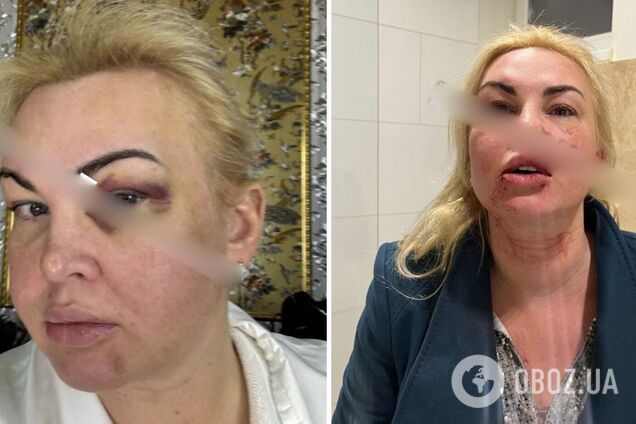 Мережу шокували фото Камалії в синцях та крові: співачка відреагувала