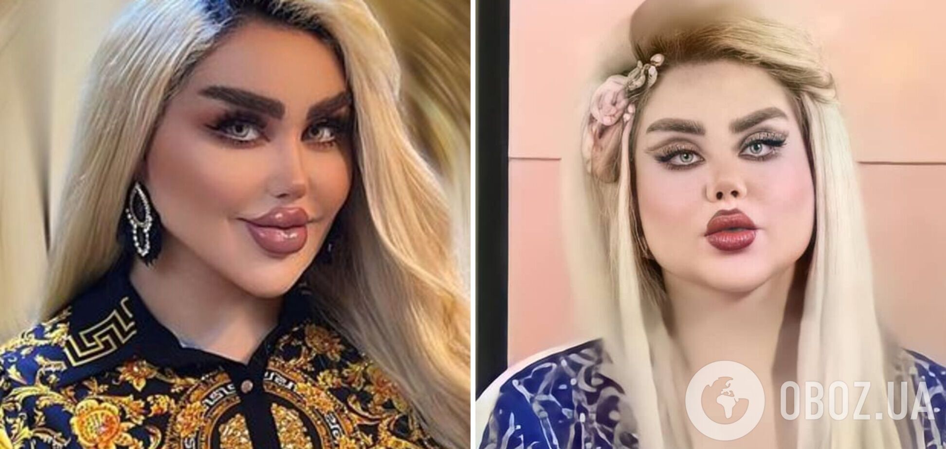 Жінка з Іраку зробила 43 операції, щоб стати схожою на ляльку Барбі. Ось що з цього вийшло