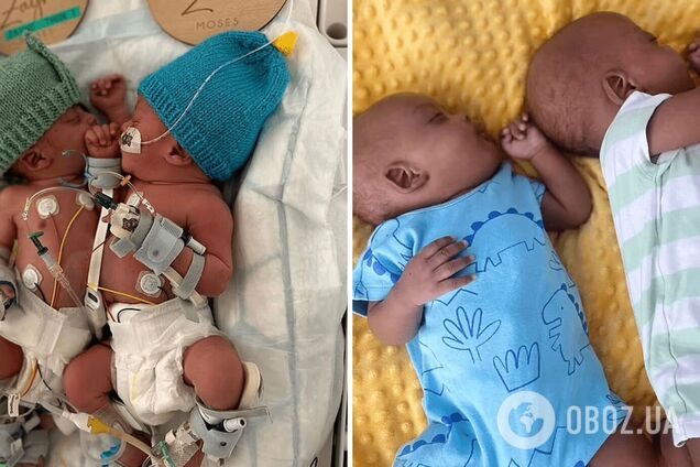 Сиамские близнецы из Лондона, разделенные в три месяца, отпраздновали свой первый день рождения. Как выглядят сейчас Зейн и Сион