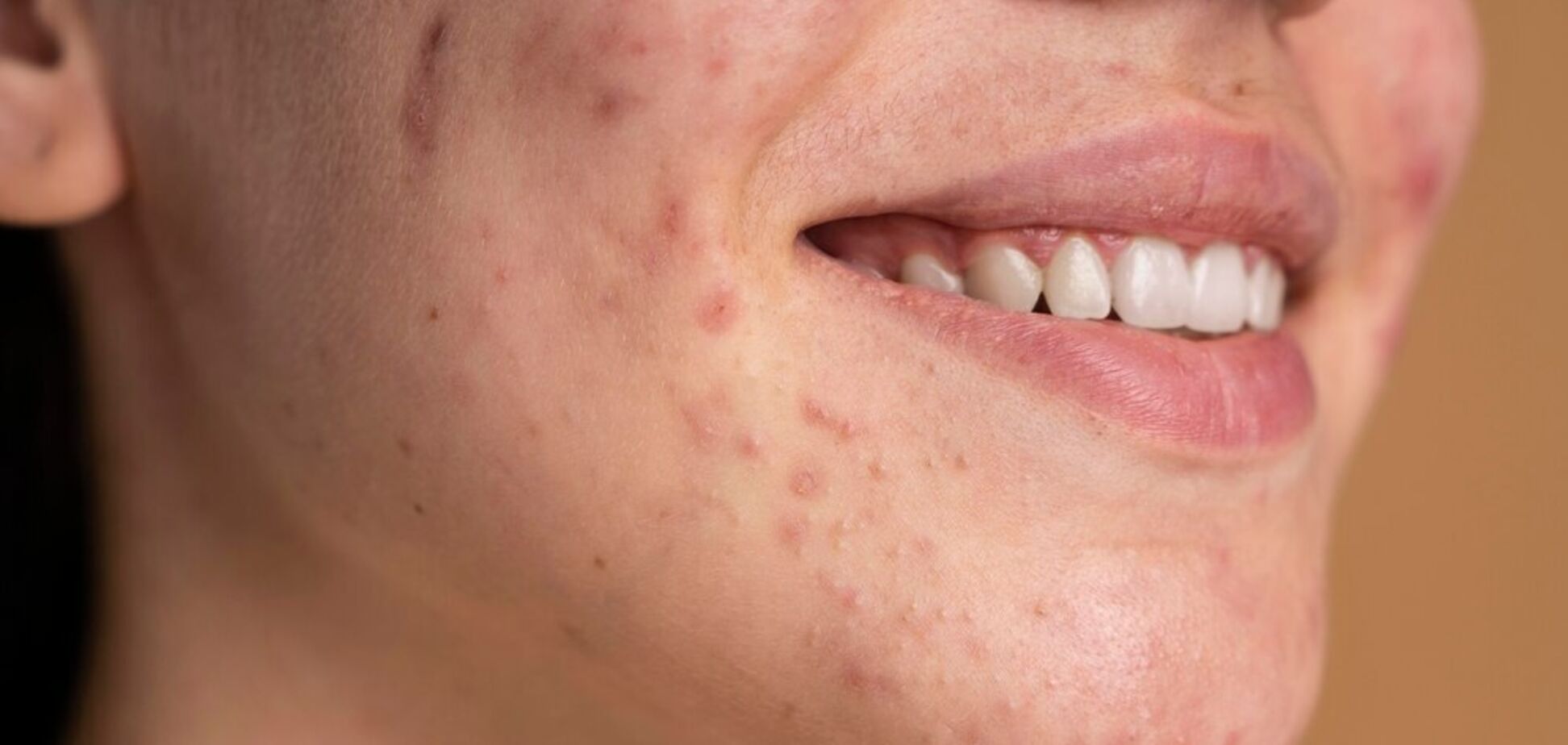 4 способи зменшити появу шрамів після прищів натуральними засобами