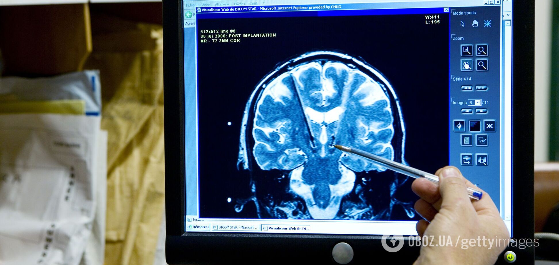 Вчені вставили 'вікно' в череп людини, щоб заглянути в її мозок