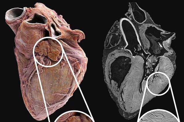 Как выглядит сердце человека изнутри: ученые показали разницу между здоровым и больным органом. Впечатляющее видео