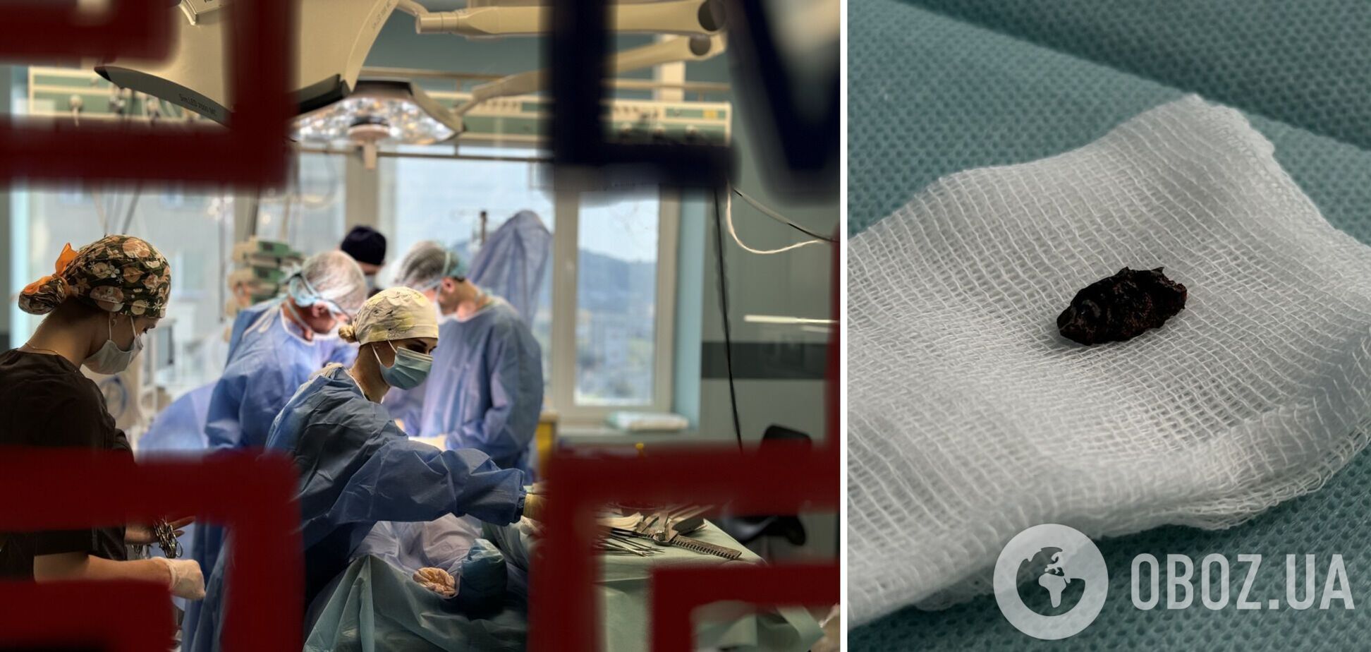 На спасение было мало времени: львовские кардиохирурги извлекли из сердца 22-летней девушки российский осколок. Фото