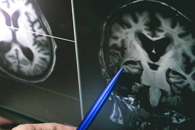 Мозок чоловіків має інший вигляд: вчені пояснили, чому жінки більш емоційні та гірше орієнтуються в просторі