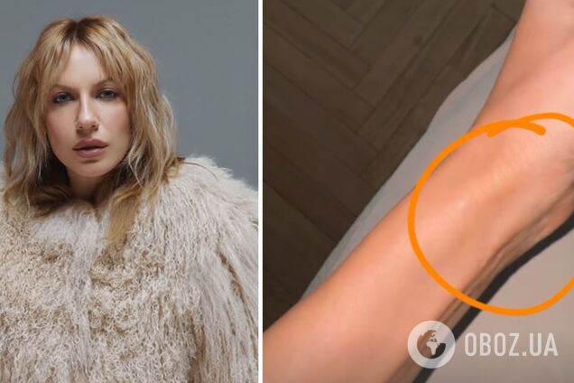 Леся Никитюк переполошилась из-за опухоли на руке и объяснила, почему не может пойти к врачу: подписчики помогли ей с диагнозом