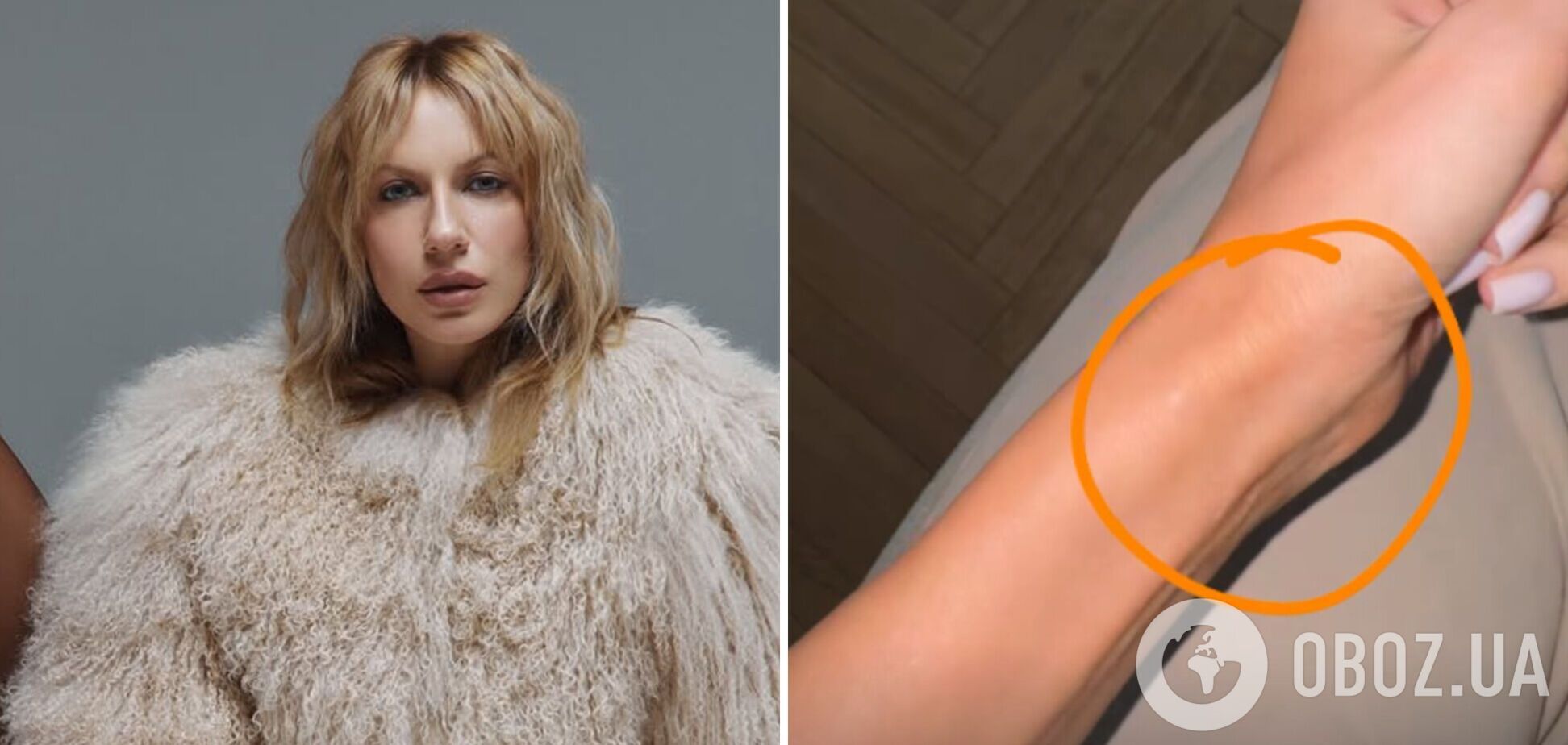 Леся Нікітюк переполошилася через пухлину на руці та пояснила, чому не може піти до лікаря: підписники допомогли їй з діагнозом