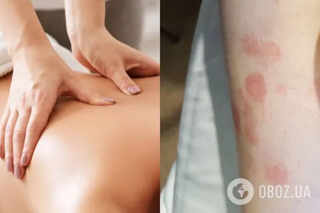 У работниц спа-центра в Румынии зафиксировали случаи опасной болезни: выявлено впервые за 44 года