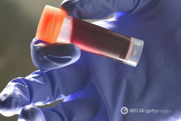 Какая группа крови повышает риск раннего инсульта: что выяснили генетики