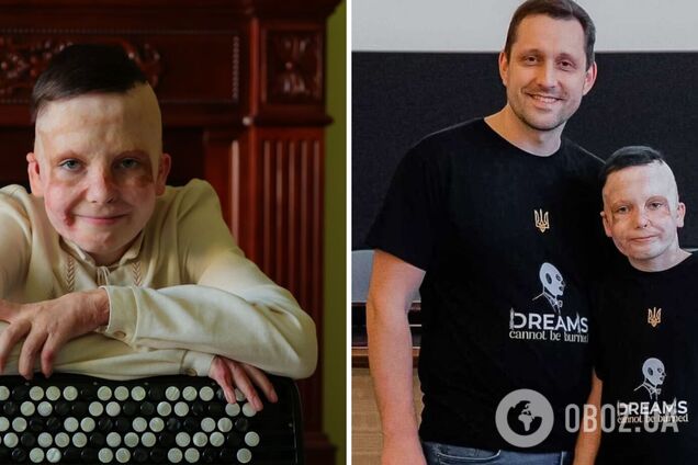 'Мамине взуття – тепер воно моє': як зараз живе 10-річний Роман Олексів, який втратив матір і отримав страшні опіки через удар РФ. Фото і відео