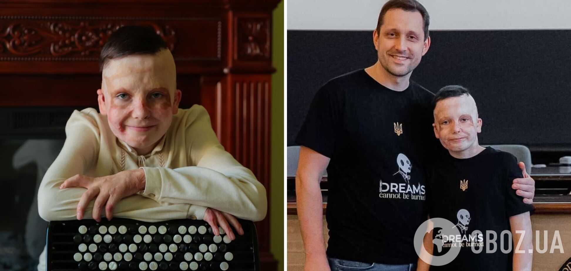 'Мамина обувь – теперь она моя': как сейчас живет 10-летний Роман Олексив, который потерял мать и получил страшные ожоги из-за удара РФ. Фото и видео