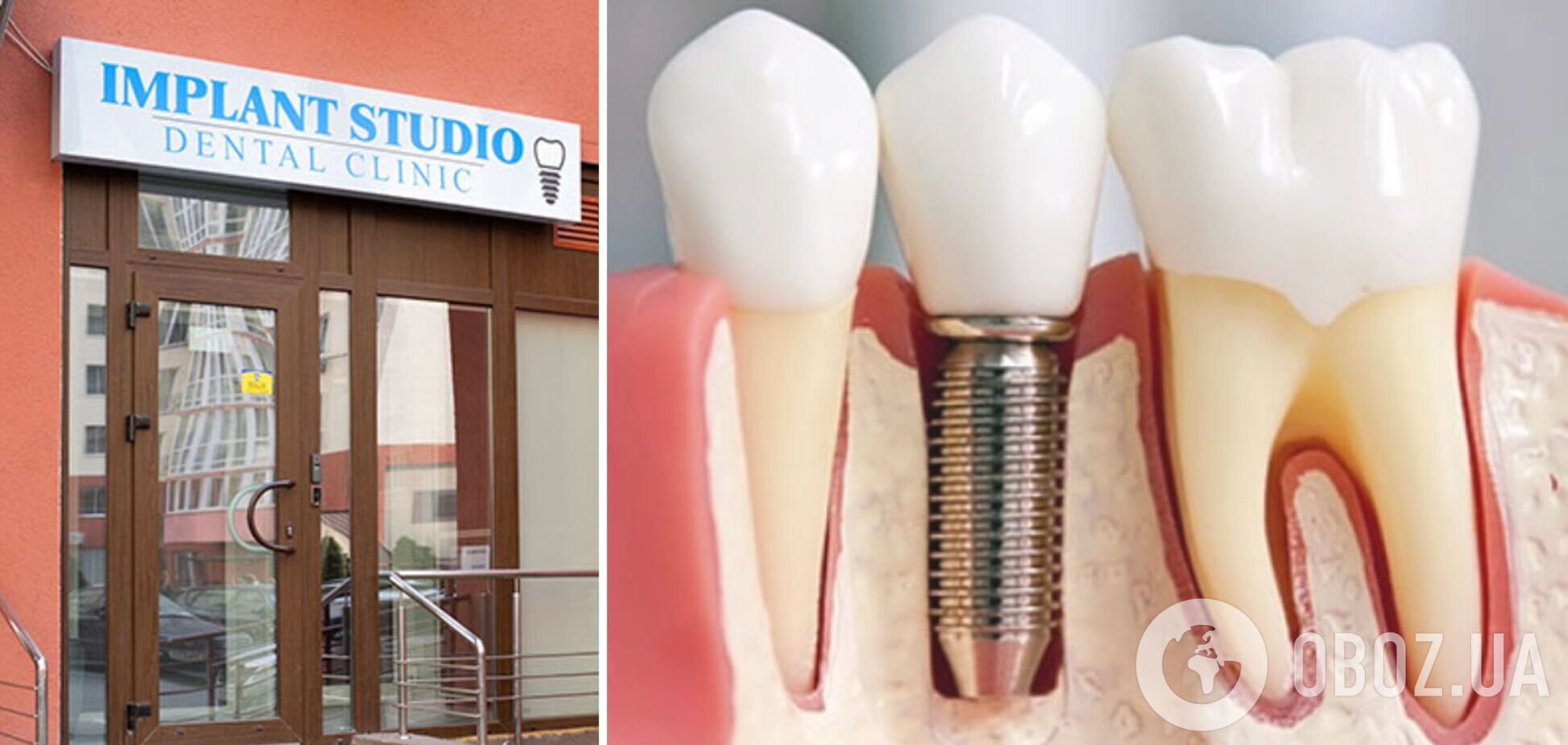 Имплантация зубов в Украине: техники, материалы и цены