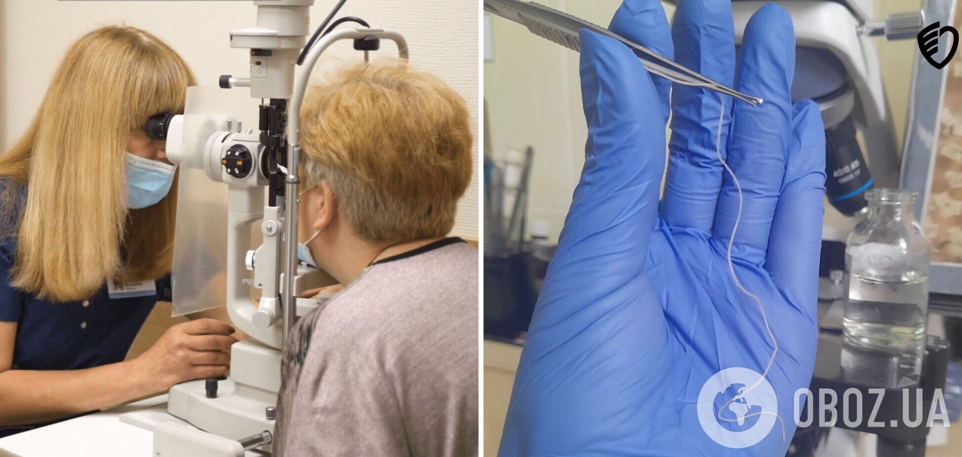 Скаржилася на слабкість і набряки: на Рівненщині з ока у жінки дістали 11-сантиметрового гельмінта. Фото