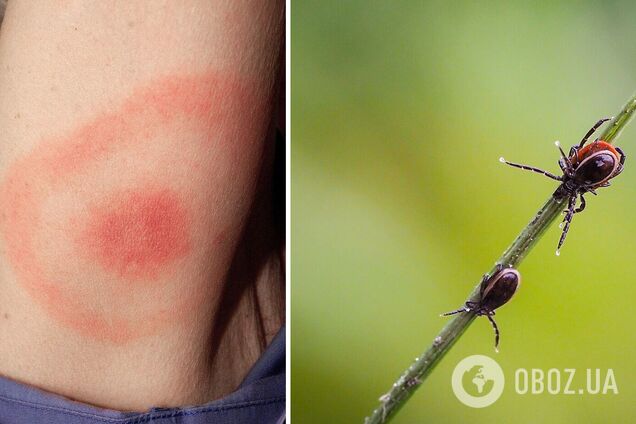 Кліщі атакують: у Києві зафіксували зростання кількості хворих на хворобу Лайма. Подробиці