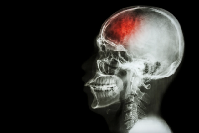 Швейцарські вчені розробили метод відновлення мозку після інсульту: як він працює